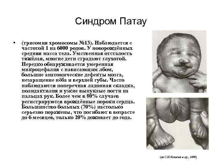 Синдром Патау • (трисомия хромосомы № 13). Наблюдается с частотой 1 на 6000 родов.
