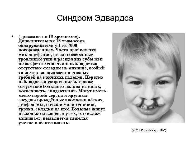 Синдром Эдвардса • (трисомия по 18 хромосоме). Дополнительная 18 хромосома обнаруживается у 1 из