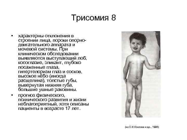Трисомия 8 • • характерны отклонения в строении лица, пороки опорнодвигательного аппарата и мочевой