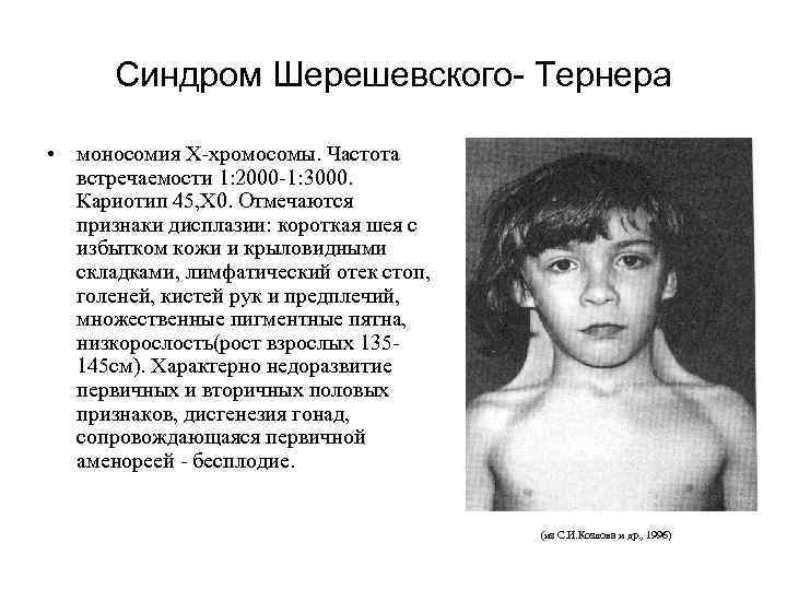 Синдром Шерешевского- Тернера • моносомия X-хромосомы. Частота встречаемости 1: 2000 -1: 3000. Кариотип 45,