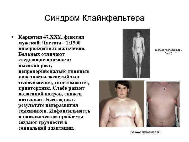 Синдром Клайнфельтера • Кариотип 47, XXY, фенотип мужской. Частота - 1: 1500 новорожденных мальчиков.
