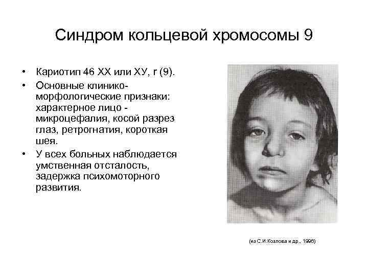 Синдром кольцевой хромосомы 9 • Кариотип 46 ХХ или ХУ, r (9). • Основные