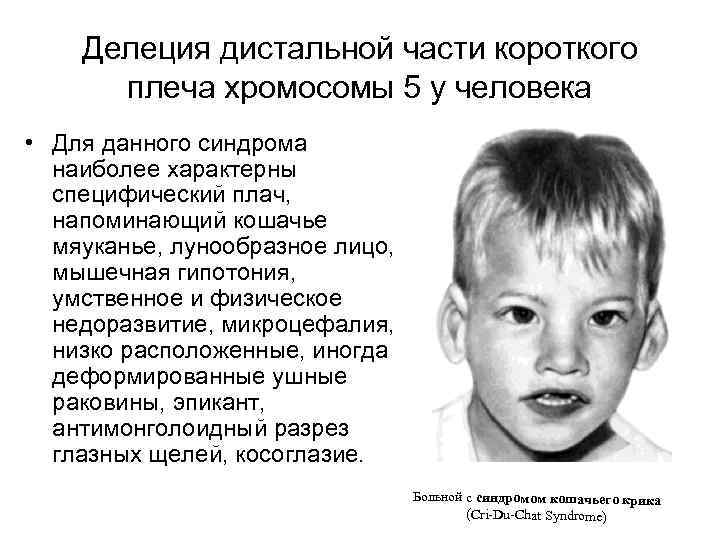 Делеция дистальной части короткого плеча хромосомы 5 у человека • Для данного синдрома наиболее