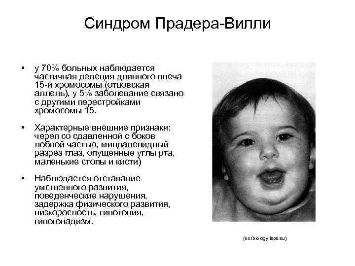 Синдром Прадера-Вилли • у 70% больных наблюдается частичная делеция длинного плеча 15 -й хромосомы