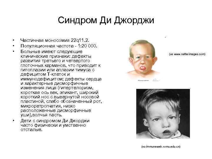 Синдром Ди Джорджи • • Частичная моносомия 22 q 11. 2. Популяционная частота -