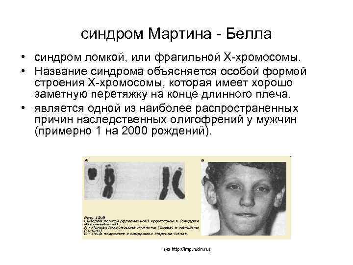 синдром Мартина - Белла • синдром ломкой, или фрагильной Х-хромосомы. • Название синдрома объясняется