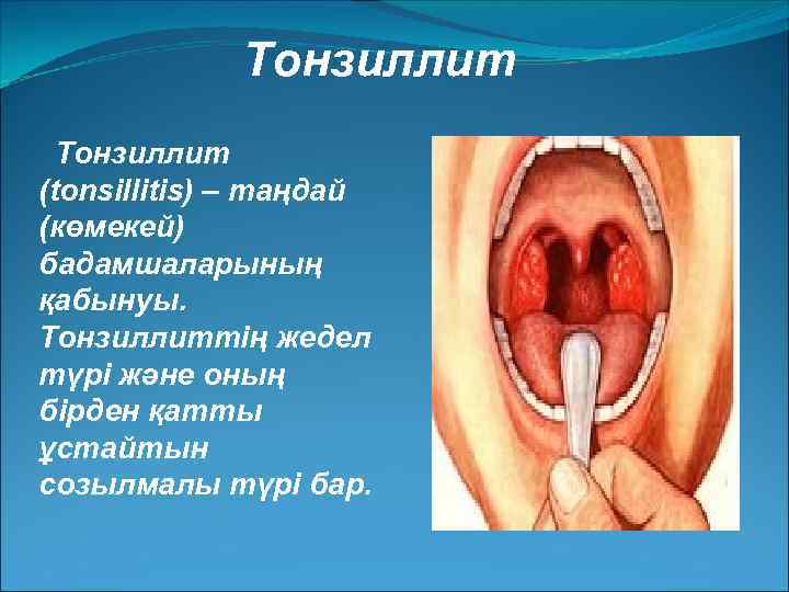 Тонзиллит (tonsіllіtіs) – таңдай (көмекей) бадамшаларының қабынуы. Тонзиллиттің жедел түрі және оның бірден қатты