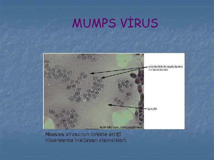 MUMPS VİRUS Measles virusunun infekte ettiği hücerelerde inklüzyon cisimcikleri. 