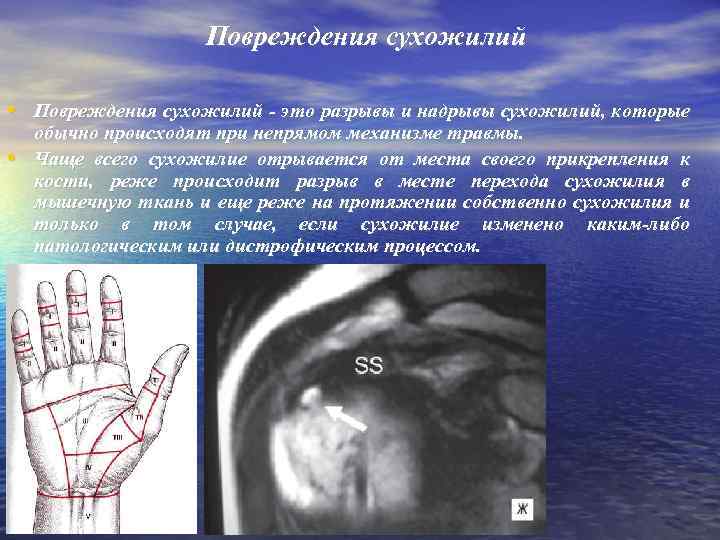 Повреждения сухожилий • Повреждения сухожилий - это разрывы и надрывы сухожилий, которые • обычно