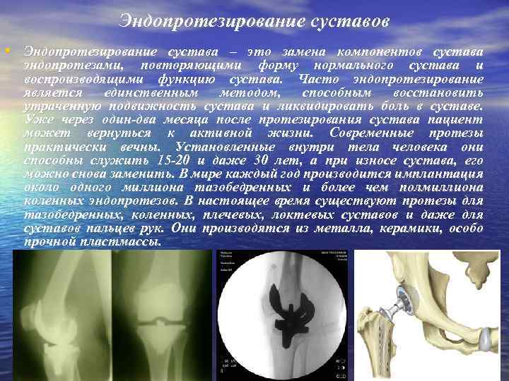 Эндопротезирование суставов • Эндопротезирование сустава – это замена компонентов сустава эндопротезами, повторяющими форму нормального
