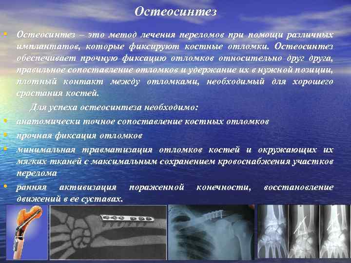 Остеосинтез • Остеосинтез – это метод лечения переломов при помощи различных имплантатов, которые фиксируют