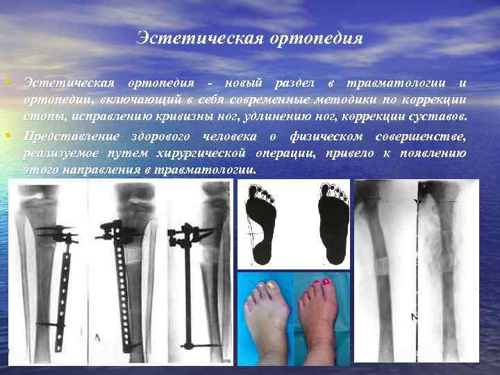 Эстетическая ортопедия • Эстетическая ортопедия - новый раздел в травматологии и • ортопедии, включающий