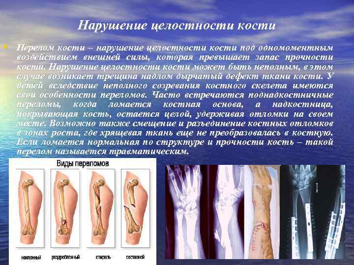 Нарушение целостности кости • Перелом кости – нарушение целостности кости под одномоментным воздействием внешней