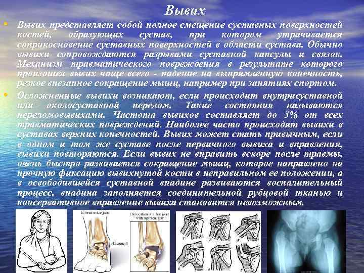 Вывих • Вывих представляет собой полное смещение суставных поверхностей • костей, образующих сустав, при