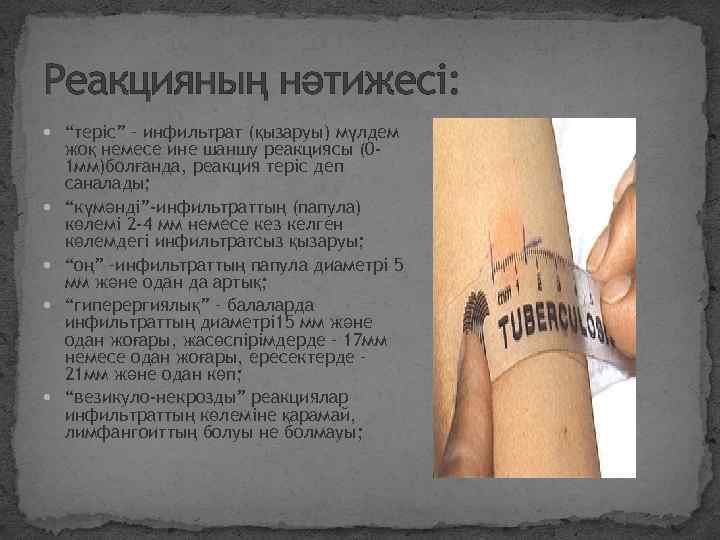 Реакцияның нәтижесі: “теріс” – инфильтрат (қызаруы) мүлдем жоқ немесе ине шаншу реакциясы (01 мм)болғанда,