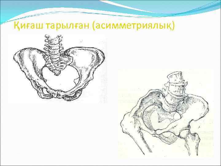 Қиғаш тарылған (асимметриялық) жамбас: 