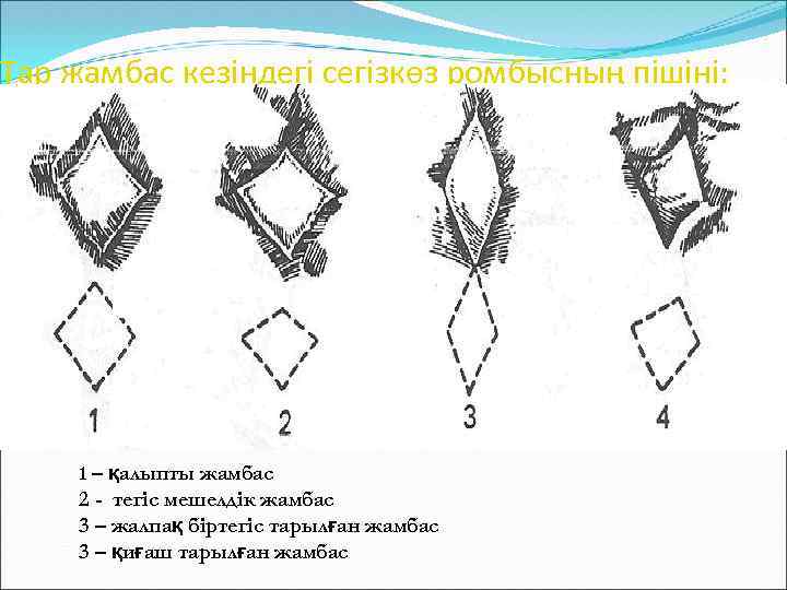 Тар жамбас кезіндегі сегізкөз ромбысның пішіні: 1 – қалыпты жамбас 2 - тегіс мешелдік