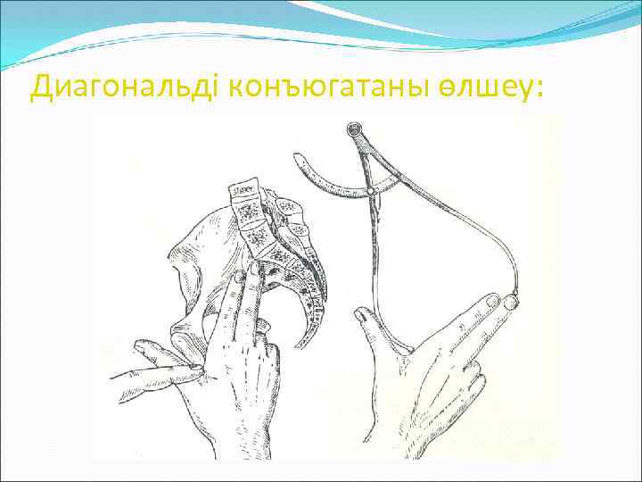 Диагональді конъюгатаны өлшеу: 