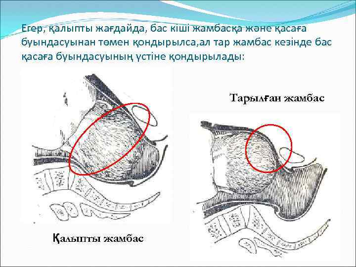 Егер, қалыпты жағдайда, бас кіші жамбасқа және қасаға буындасуынан төмен қондырылса, ал тар жамбас