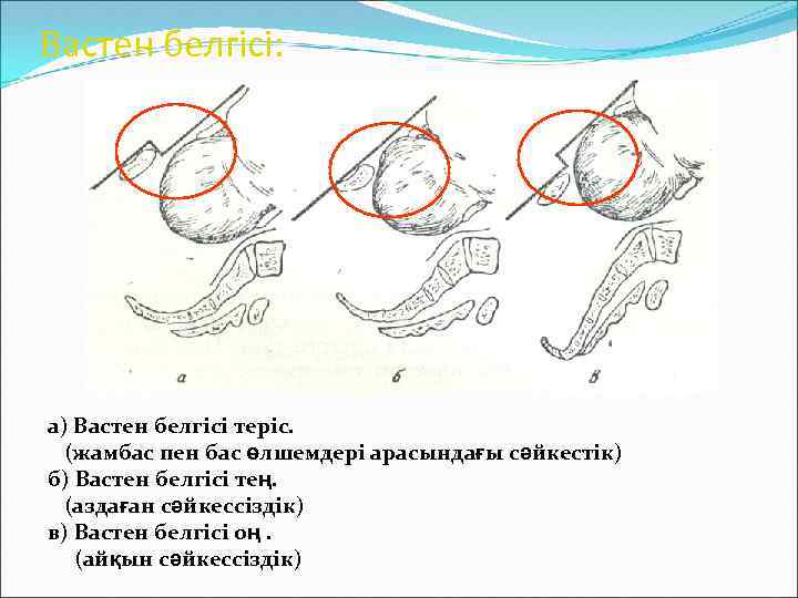 Вастен белгісі: а) Вастен белгісі теріс. (жамбас пен бас өлшемдері арасындағы сәйкестік) б) Вастен