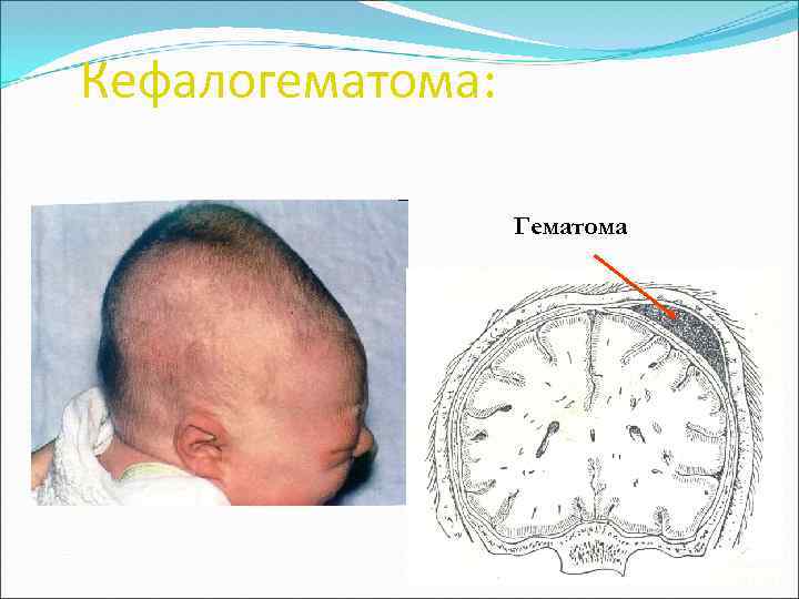 Кефалогематома: Гематома 