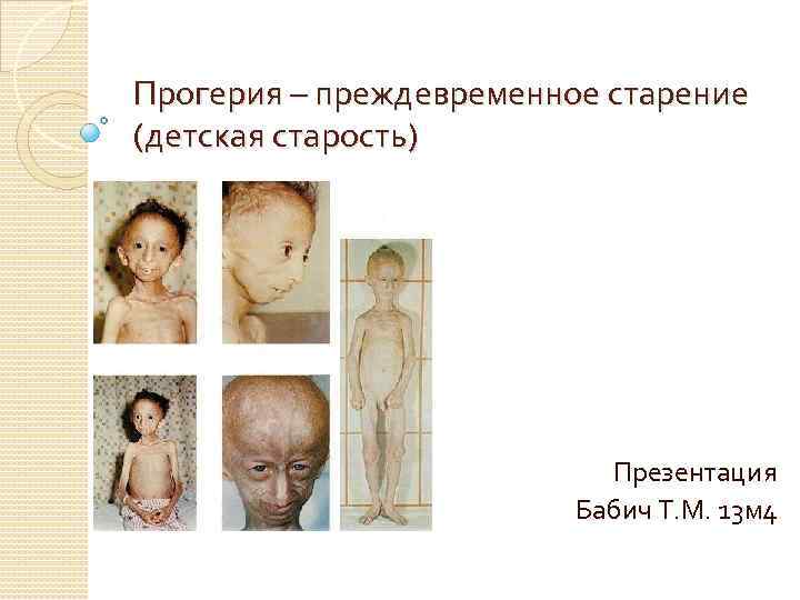 Прогерия – преждевременное старение (детская старость) Презентация Бабич Т. М. 13 м 4 