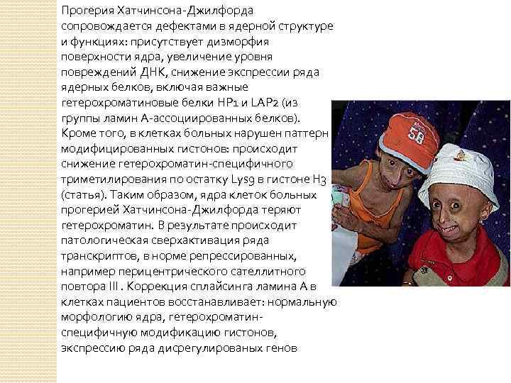 Прогерия Хатчинсона-Джилфорда сопровождается дефектами в ядерной структуре и функциях: присутствует дизморфия поверхности ядра, увеличение
