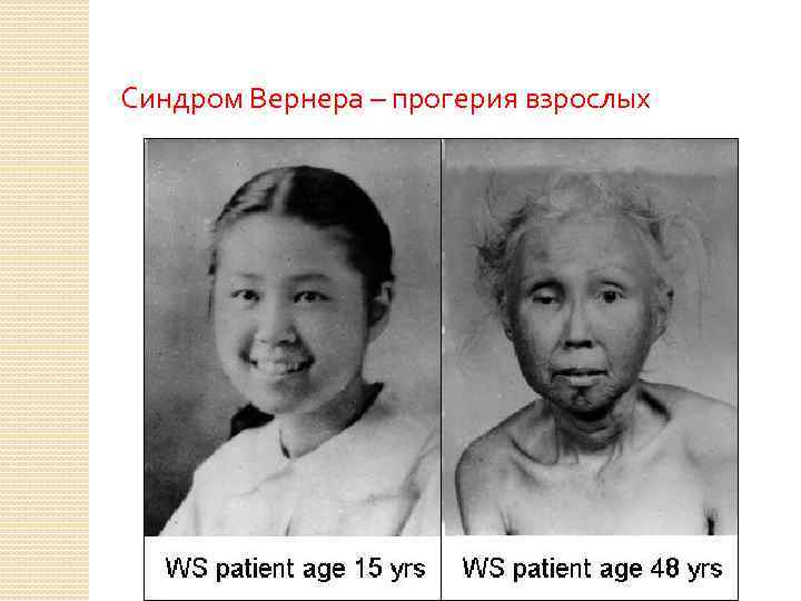 Синдром Вернера – прогерия взрослых 