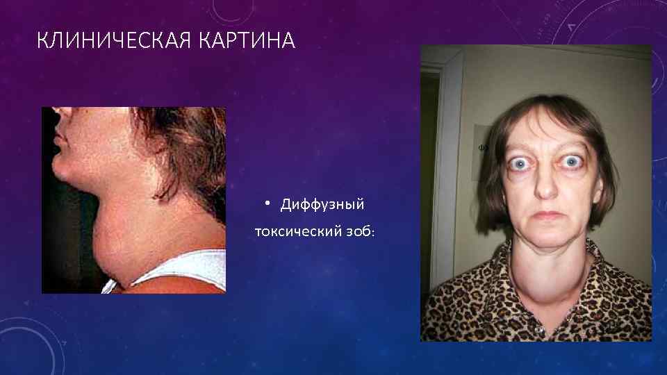 КЛИНИЧЕСКАЯ КАРТИНА • Диффузный токсический зоб: 