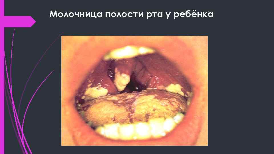 Молочница полости рта у ребёнка 