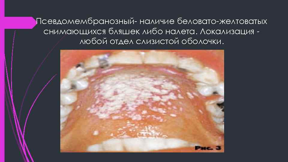 Псевдомембранозный- наличие беловато-желтоватых снимающихся бляшек либо налета. Локализация любой отдел слизистой оболочки. 