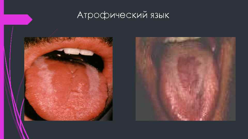 Атрофический язык 