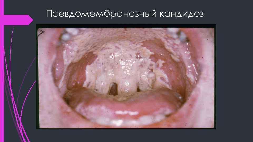 Псевдомембранозный кандидоз 