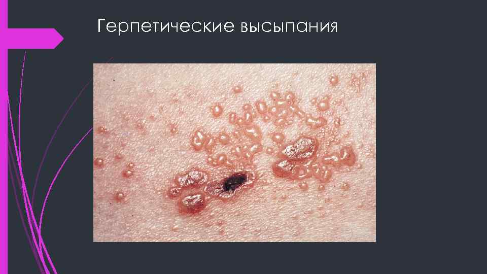 Герпетические высыпания 