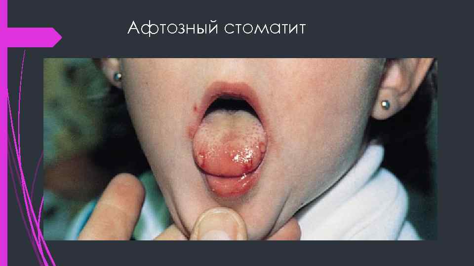 Афтозный стоматит 