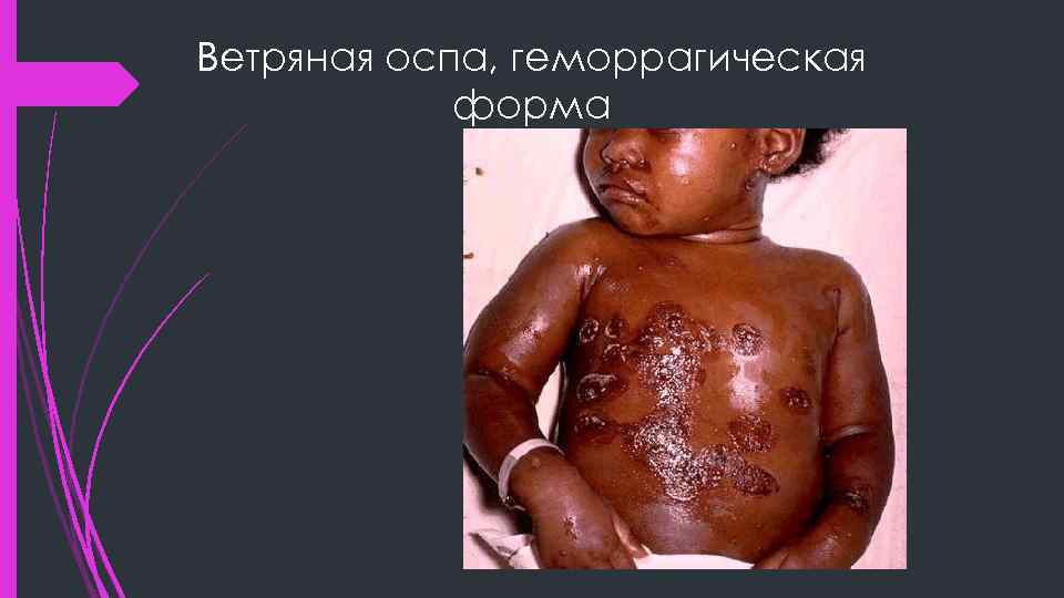 Ветряная оспа, геморрагическая форма 