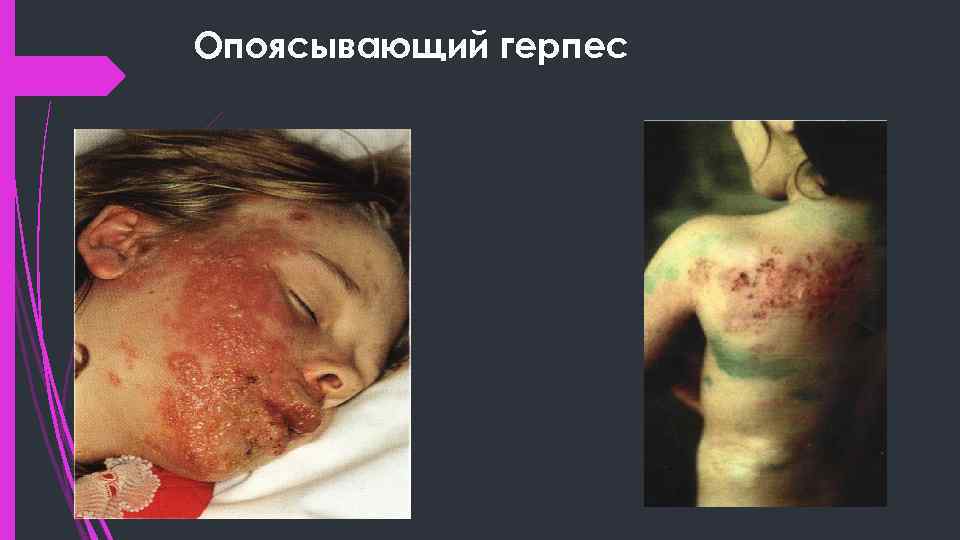 Опоясывающий герпес 