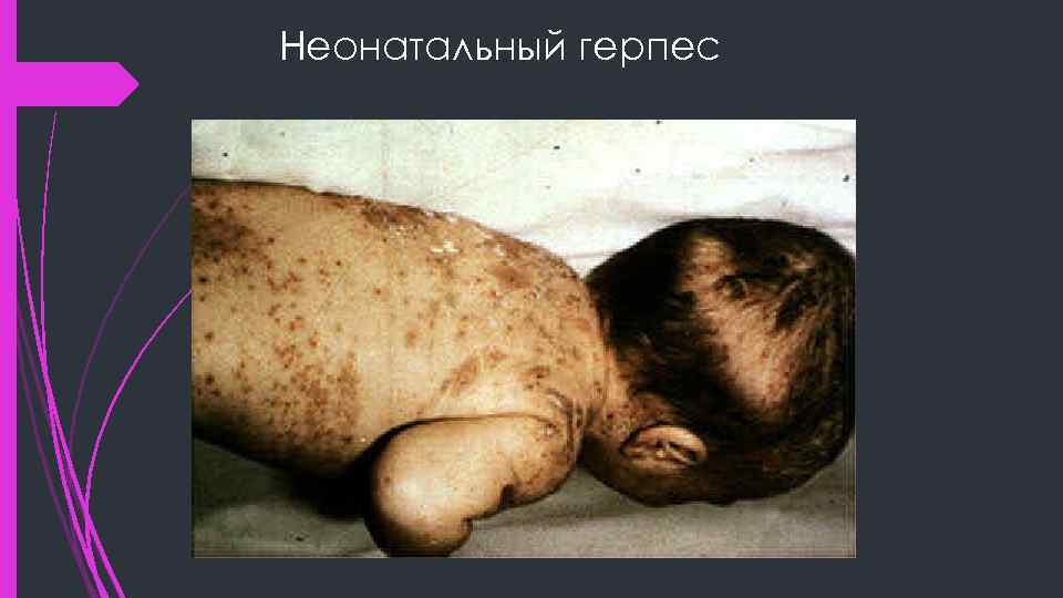 Неонатальный герпес 