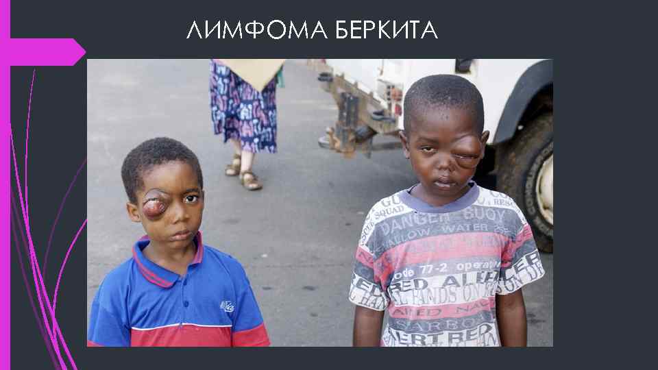ЛИМФОМА БЕРКИТА 