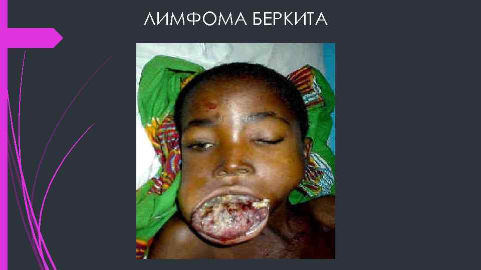 ЛИМФОМА БЕРКИТА 