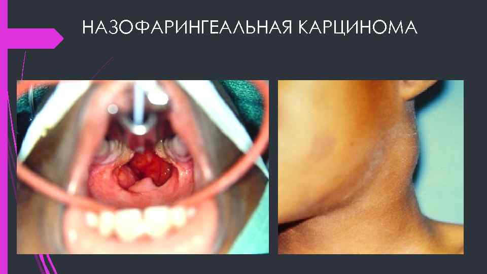 НАЗОФАРИНГЕАЛЬНАЯ КАРЦИНОМА 