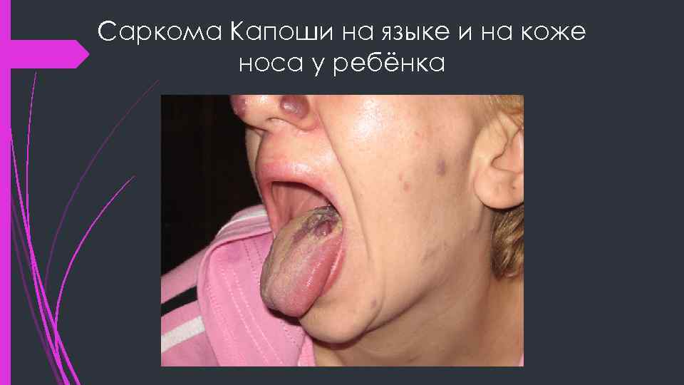 Саркома Капоши на языке и на коже носа у ребёнка 
