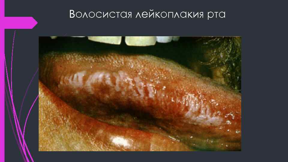 Волосистая лейкоплакия рта 