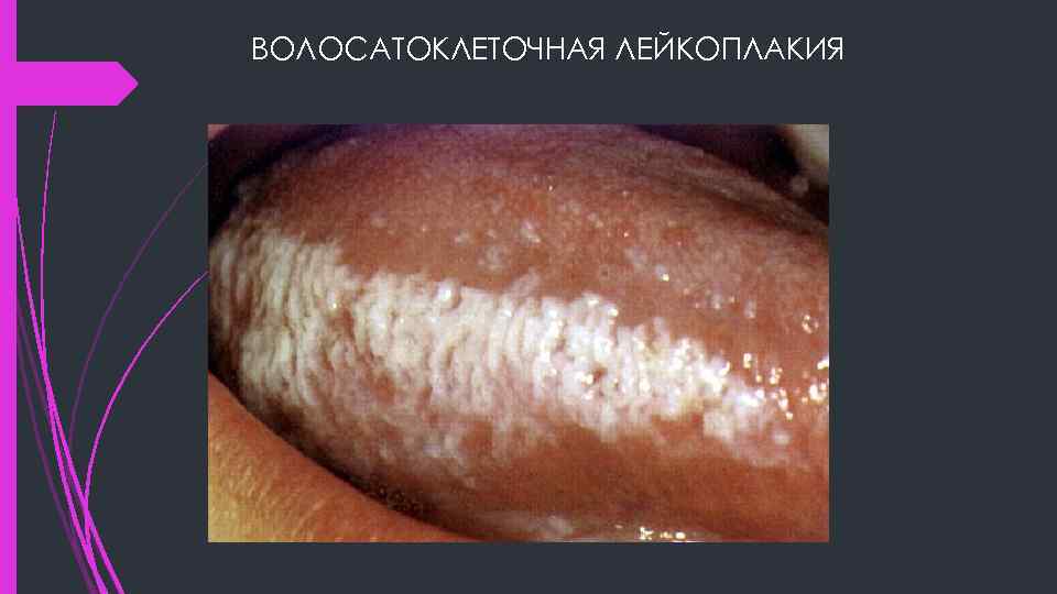 ВОЛОСАТОКЛЕТОЧНАЯ ЛЕЙКОПЛАКИЯ 