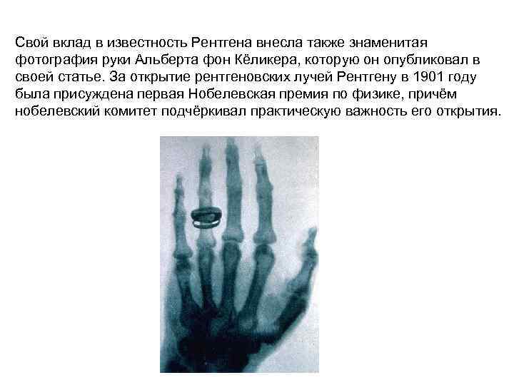Свой вклад в известность Рентгена внесла также знаменитая фотография руки Альберта фон Кёликера, которую
