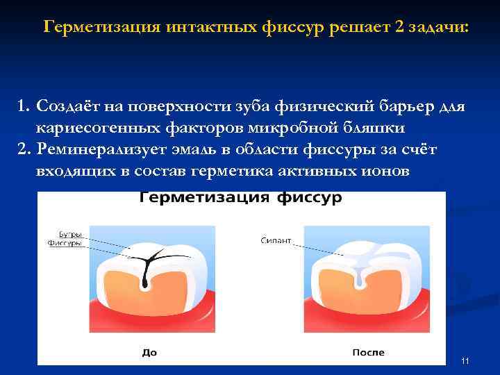 Фиссуры зубов схема