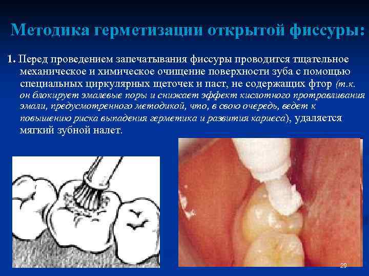 Методика герметизации открытой фиссуры: 1. Перед проведением запечатывания фиссуры проводится тщательное механическое и химическое