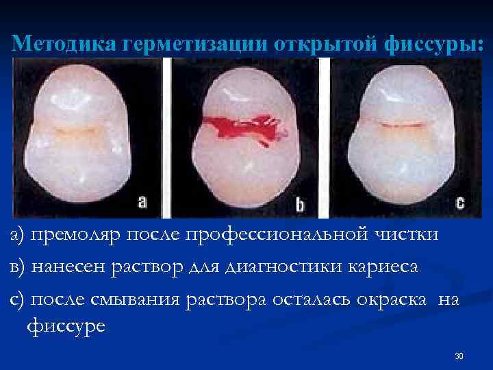 Методика герметизации открытой фиссуры: а) премоляр после профессиональной чистки в) нанесен раствор для диагностики