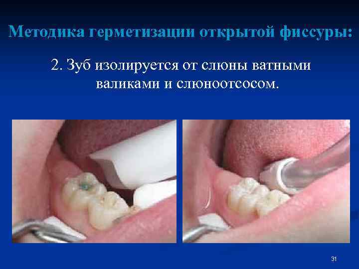 Методика герметизации открытой фиссуры: 2. Зуб изолируется от слюны ватными валиками и слюноотсосом. 31