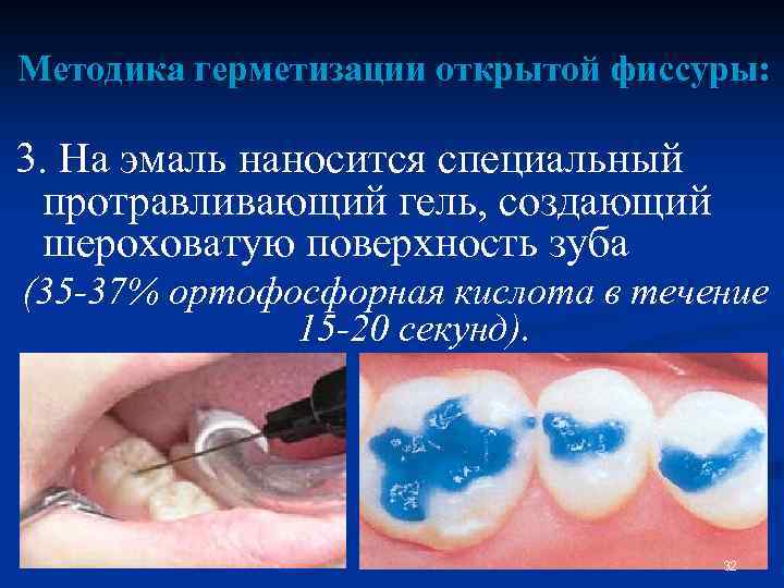 Методика герметизации открытой фиссуры: 3. На эмаль наносится специальный протравливающий гель, создающий шероховатую поверхность